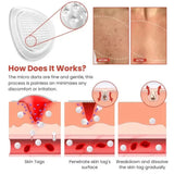 DermaSmooth Skin Tag Remover Patch |  Fast, Safe & Painless Skin Tag & Mole Removal | Nano-Microneedle Technology | 72 Patches view 4